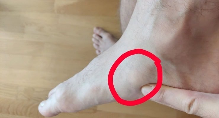 Foot issue