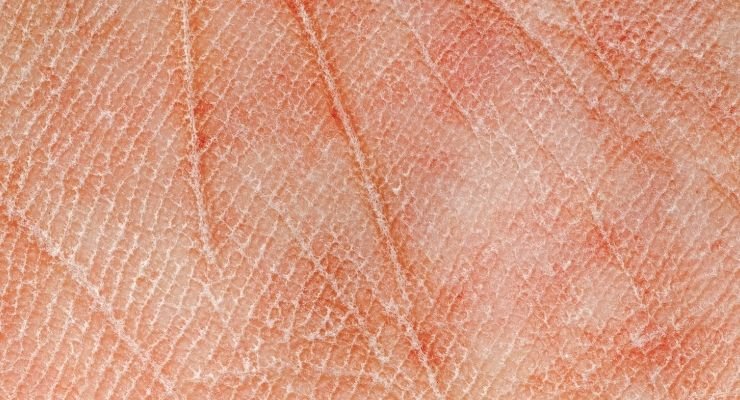 scaly dry skin