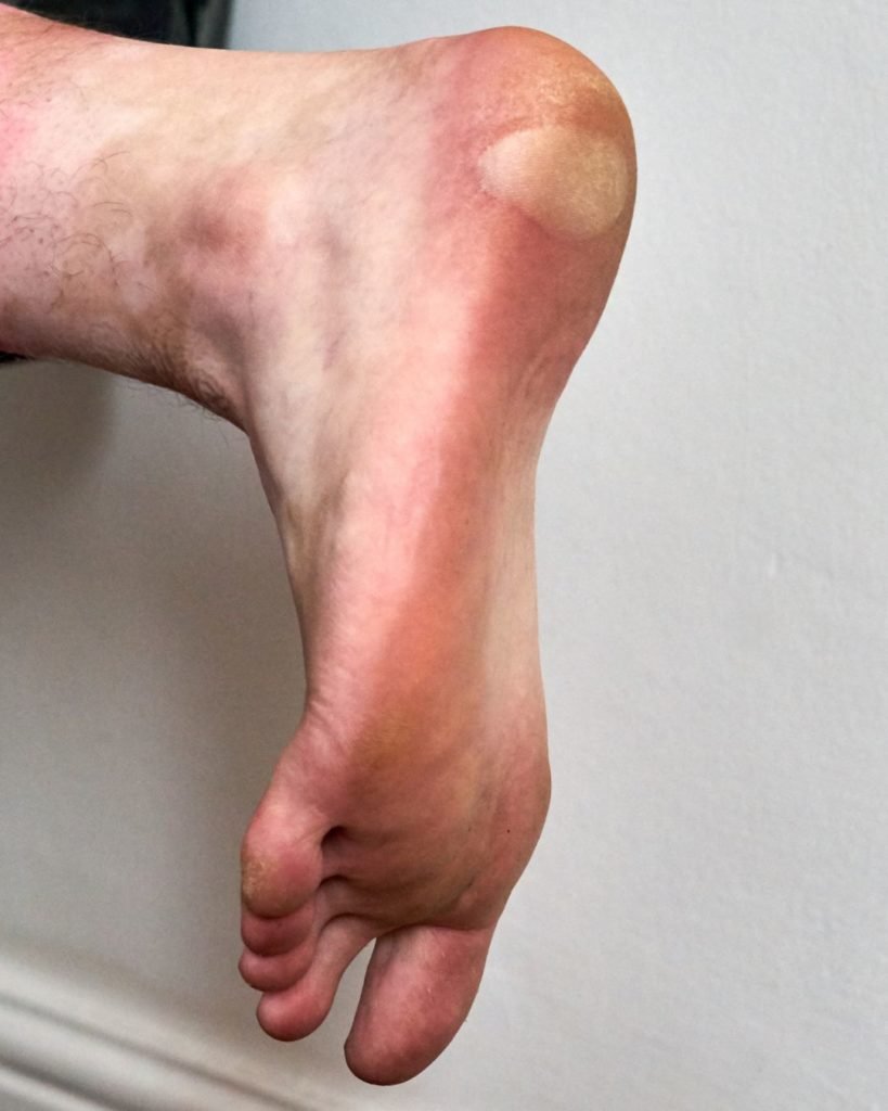 Foot Sores
