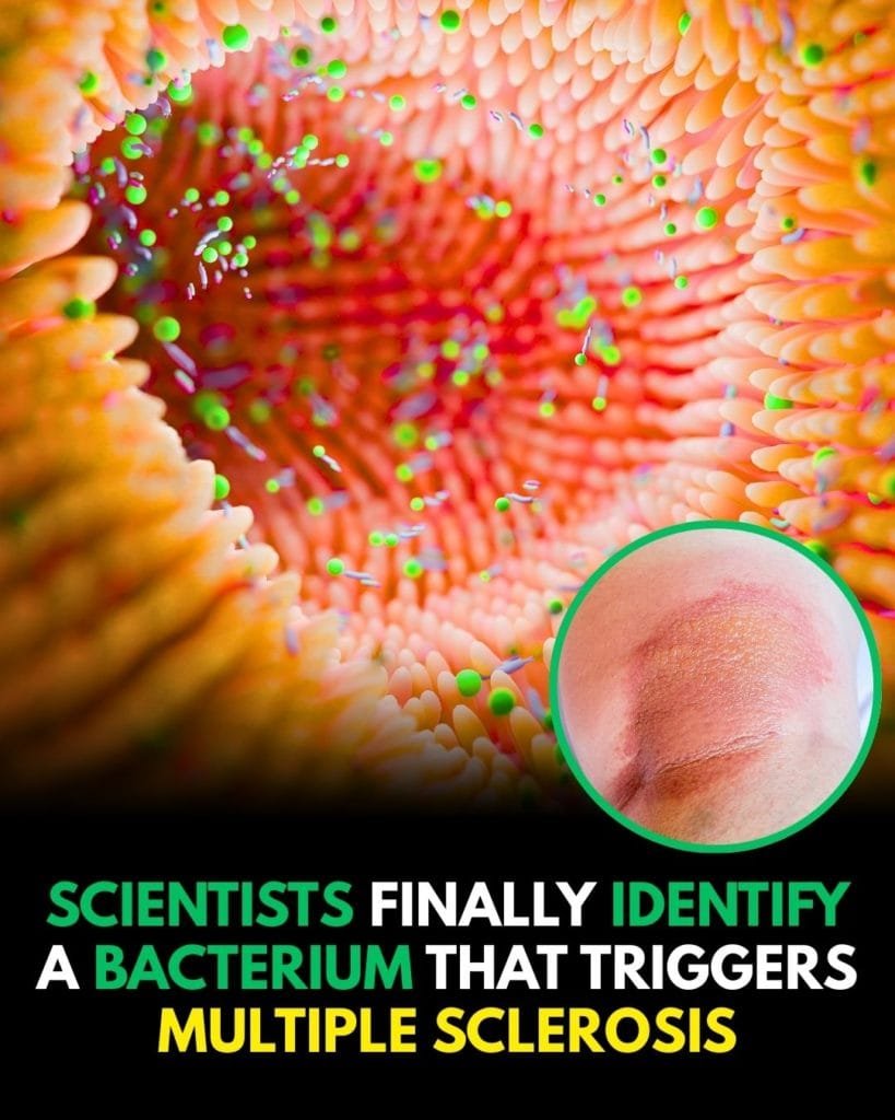 Scientists finally identify a bacterium that triggers multiple sclerosis