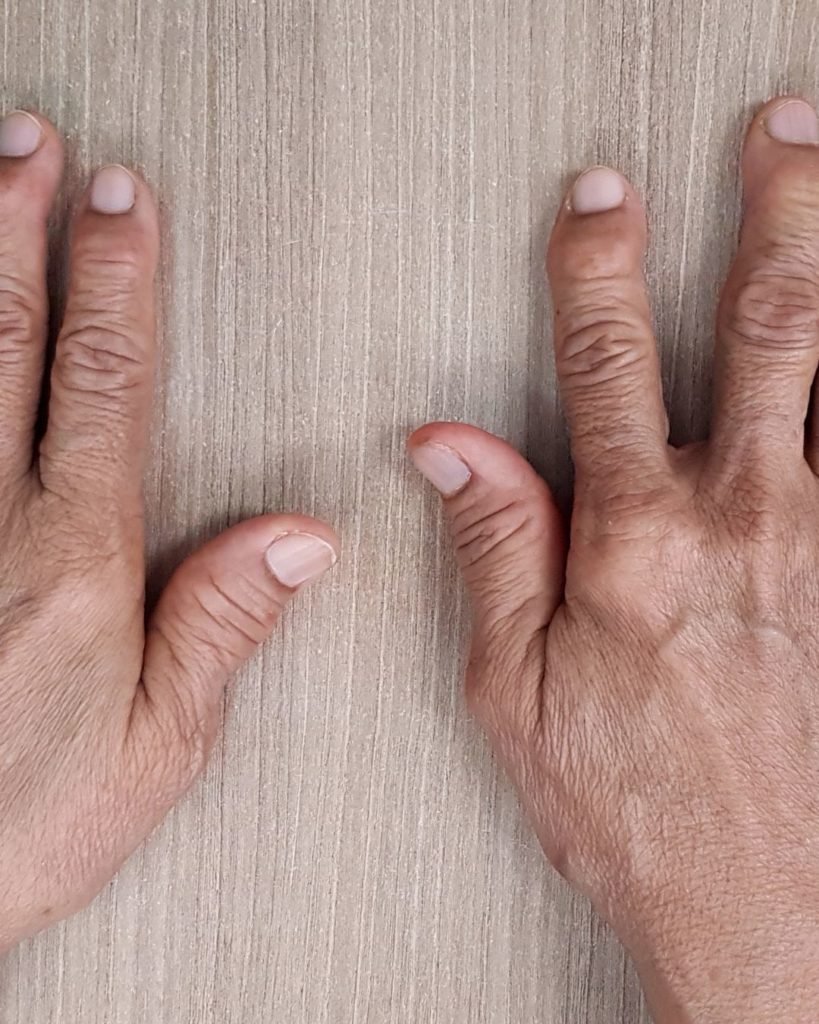 permanent finger clubbing