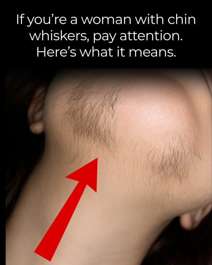 Thinning chin whiskers on women; is it a sign of aging or health issue? Learn the significance and care tips on HealthyNer.