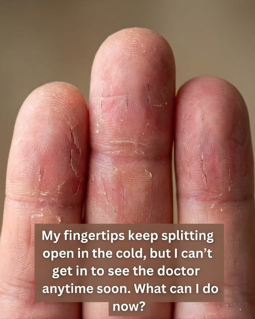 split fingertips in cold