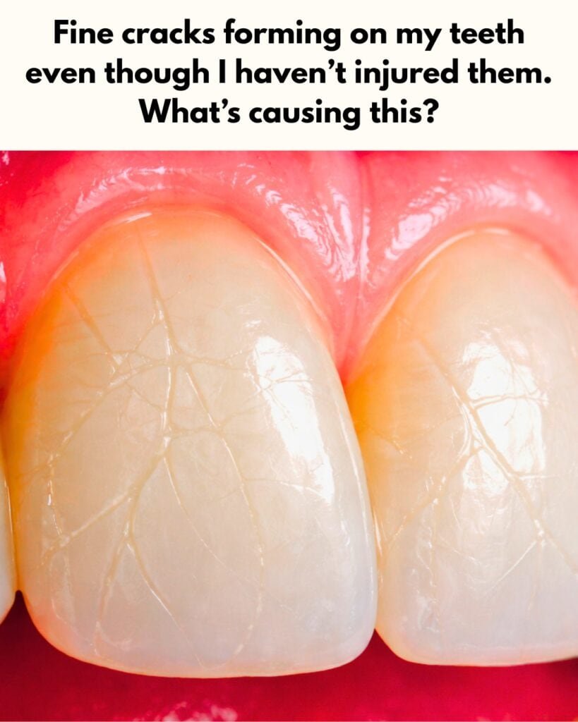 teeth cracks