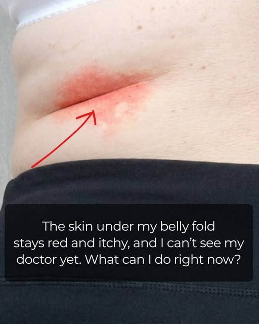 red and itchy skin under belly fold