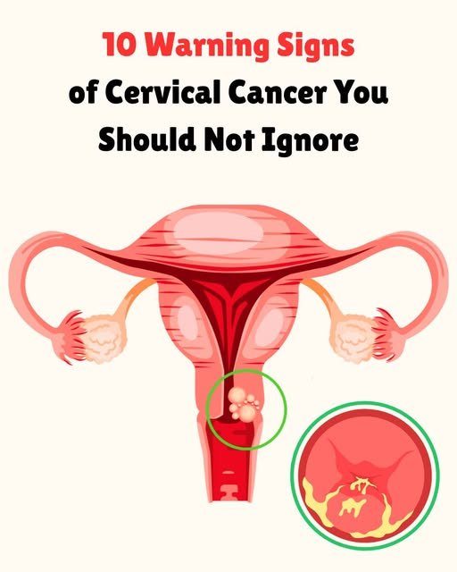 signs of cervical cancer