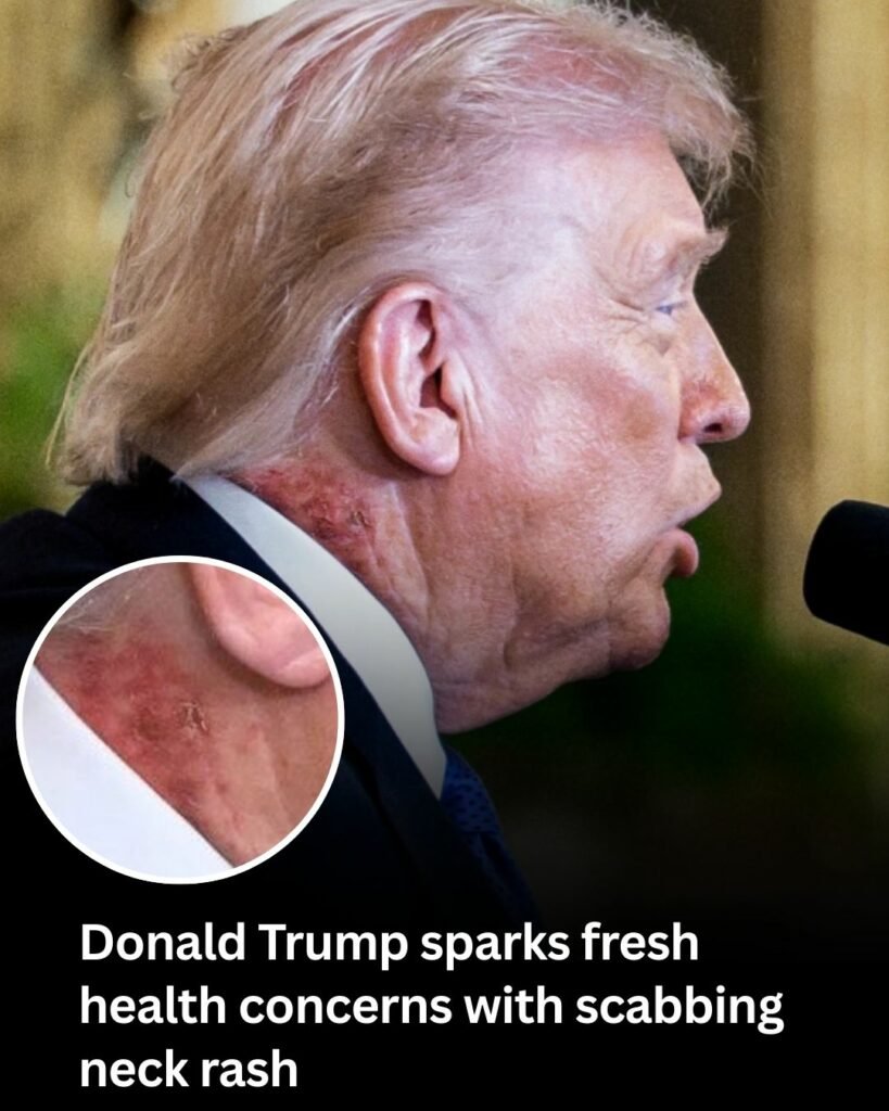 Trump's neck rash