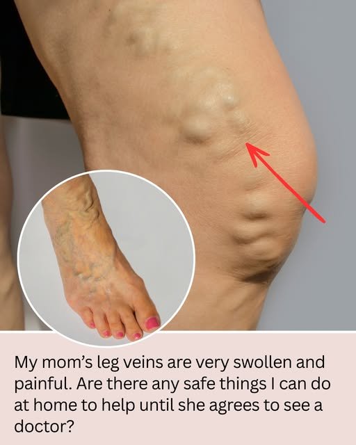 bulging veins